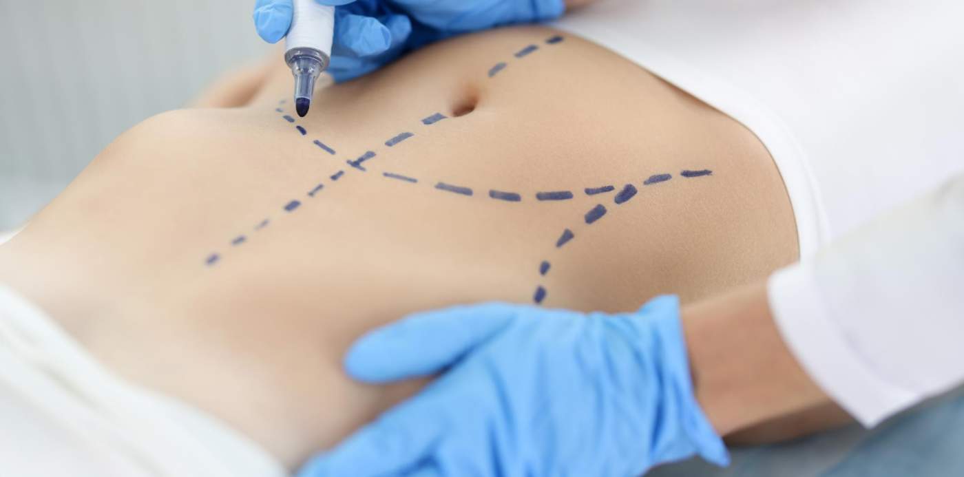 recuperación después de someterme a tratamientos de medicina estética corporal